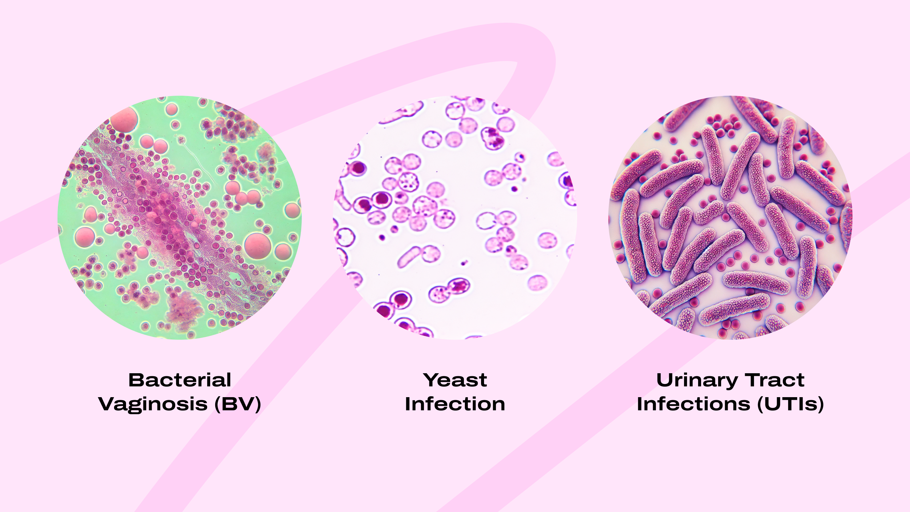 Full Guide: Key Differences Between BV, Yeast Infections, and UTIs