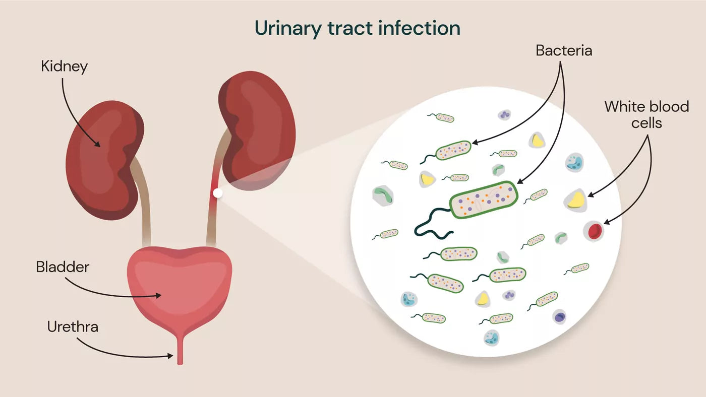 The Ultimate Guide to Preventing UTIs: What Every Woman Needs to Know